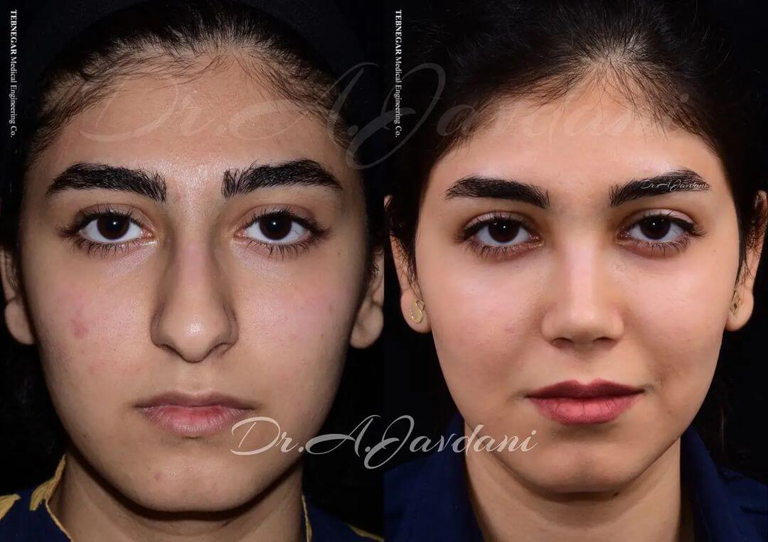 تصویر جراحی بینی قبل و بعد از عمل زیبایی
