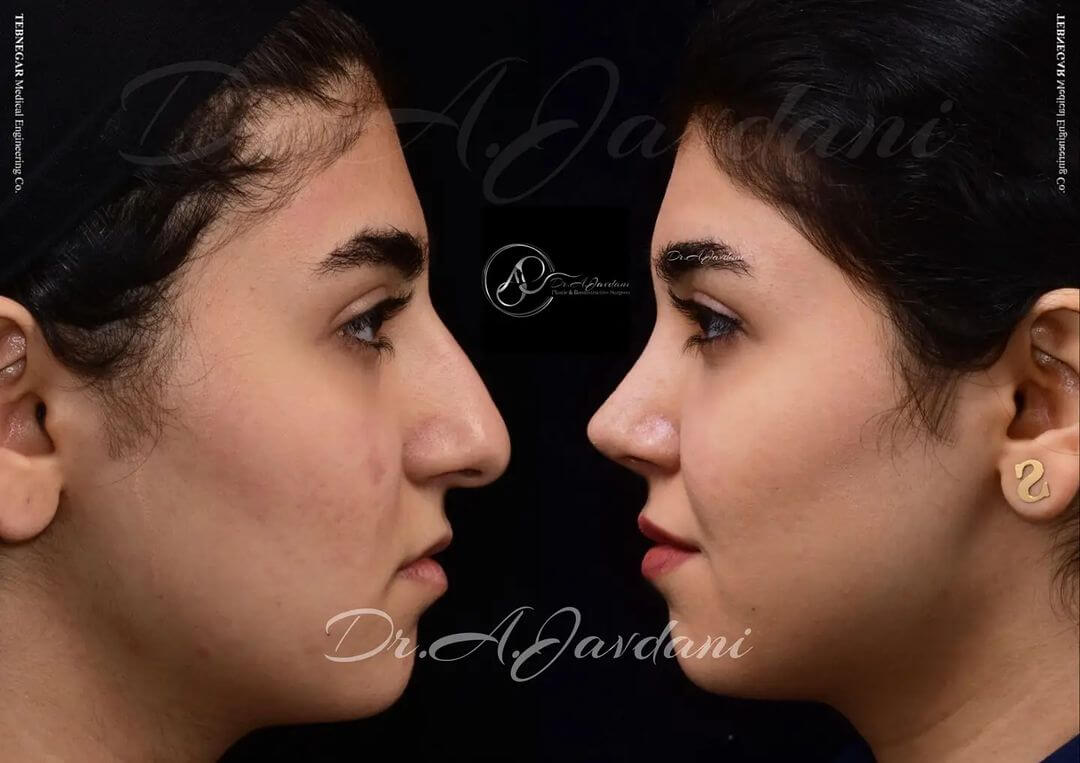 تصویر قبل و بعد از جراحی بینی زیبایی
