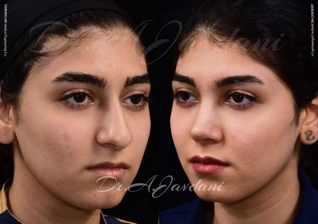 تصویر قبل و بعد از عمل جراحی بینی