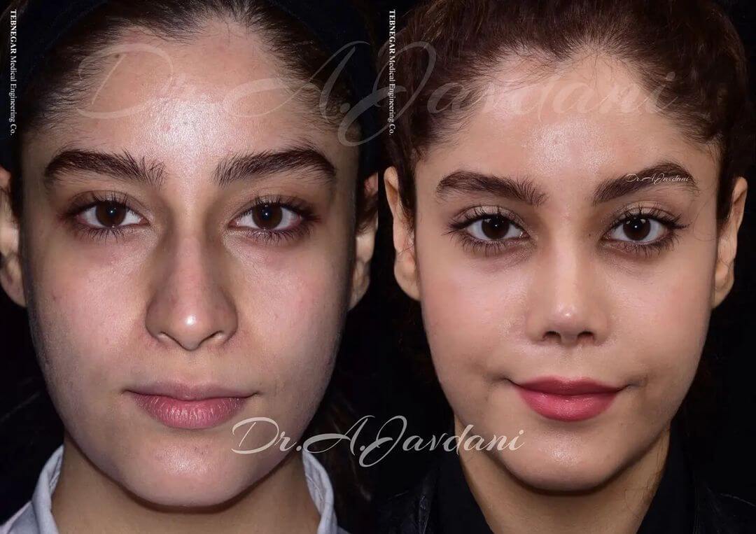 تصویر قبل و بعد از عمل اولیه ی زیبایی بینی