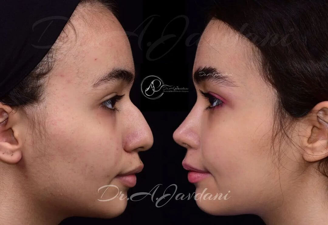 تصویر قبل و بعد از نمونه جراحی بینی