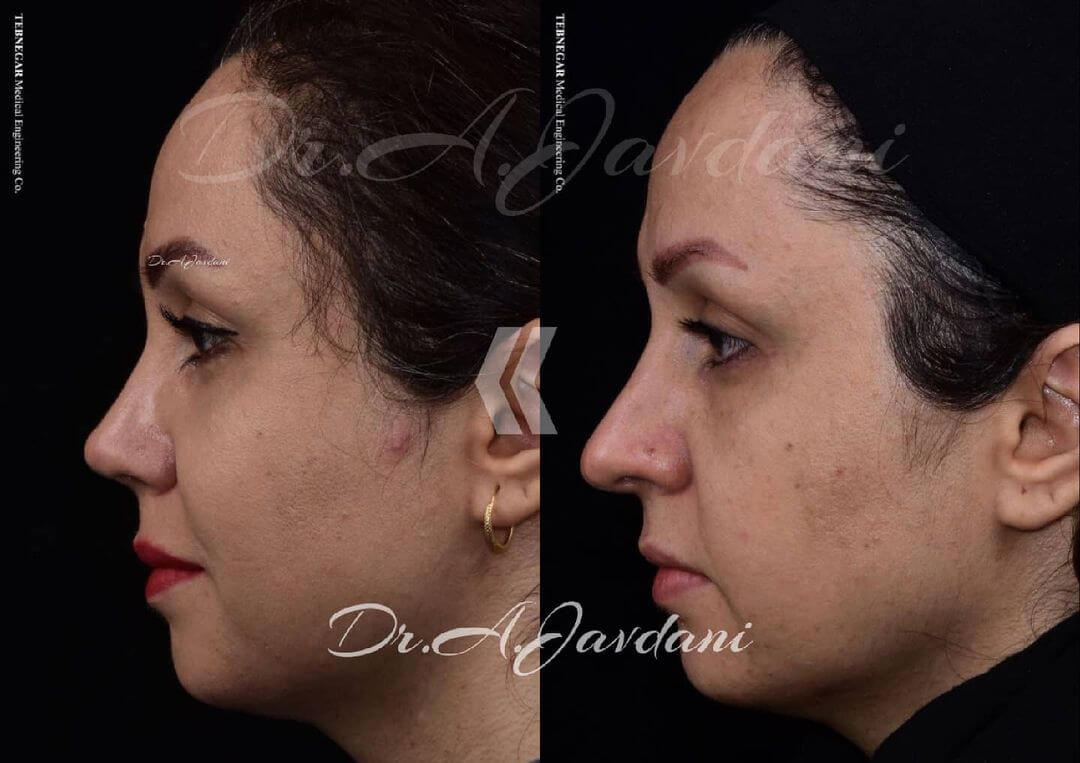 تصویر قبل و بعد از جراحی راینوپلاستی