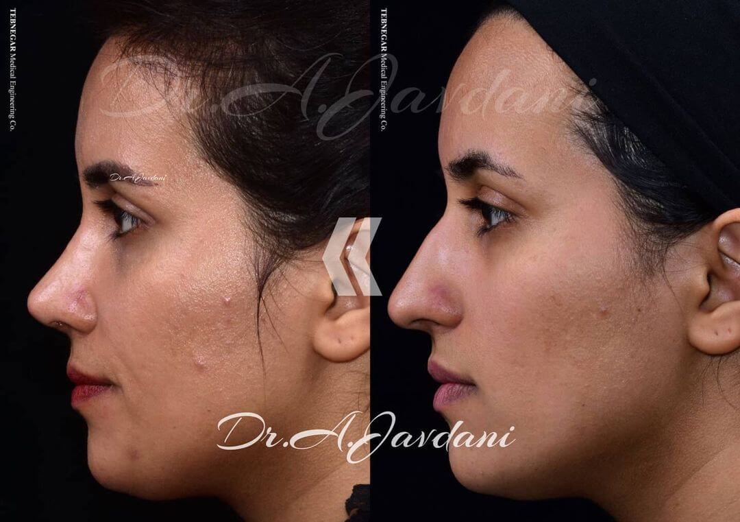 تصویر قبل و بعد از جراحی بینی طبیعی