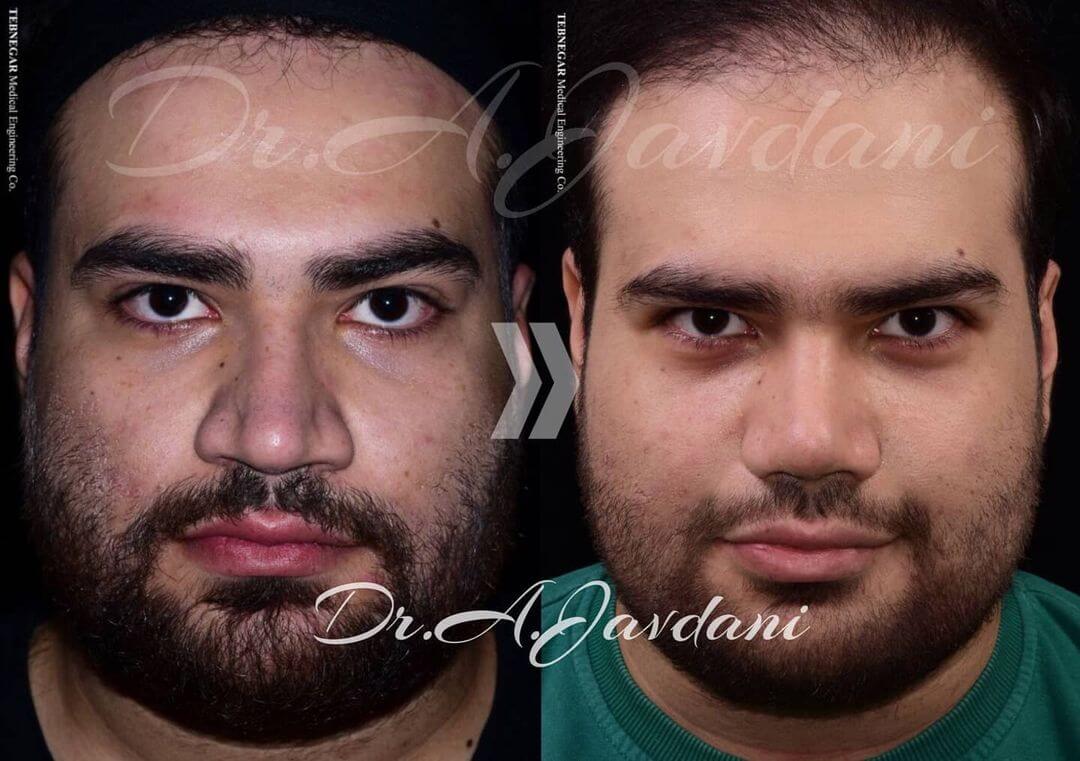 تصویر جراحی بینی مردانه یکماه بعد از جراحی