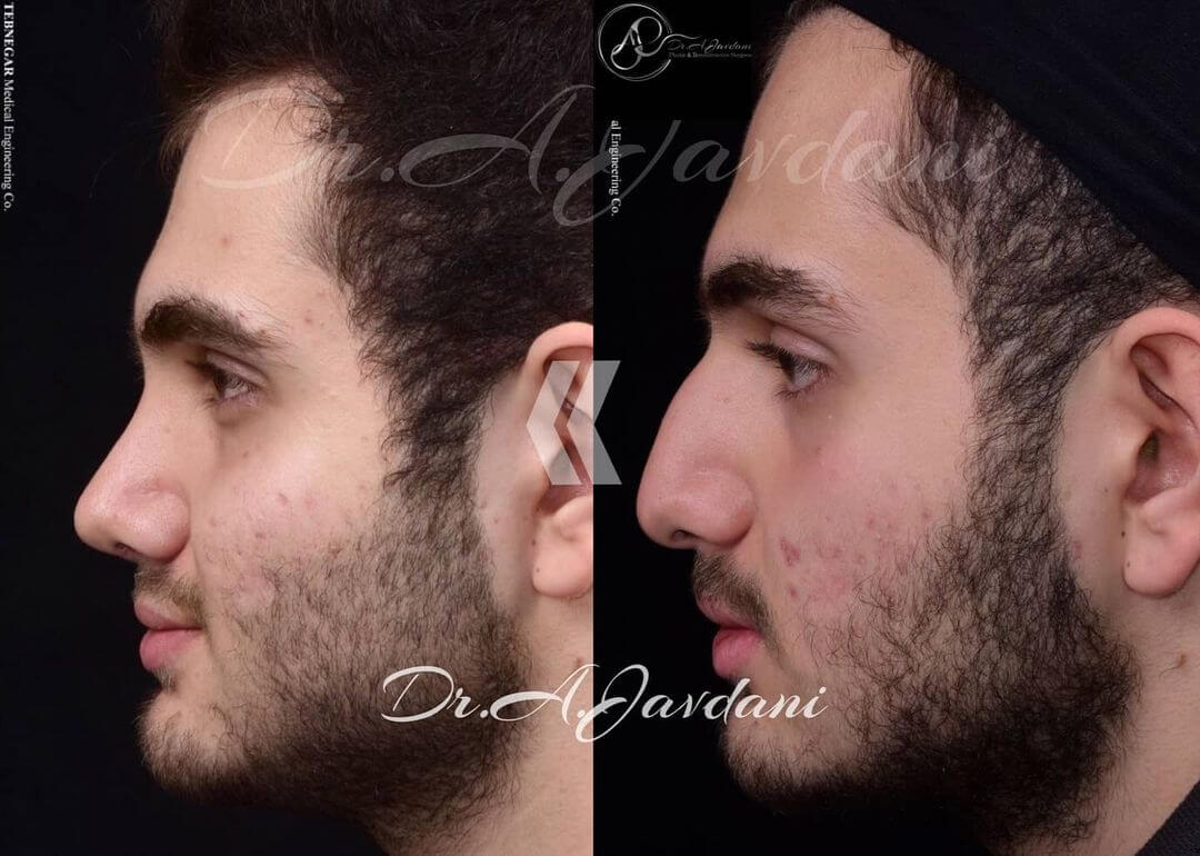 تصویر قبل و بعد از عمل بینی زیبایی