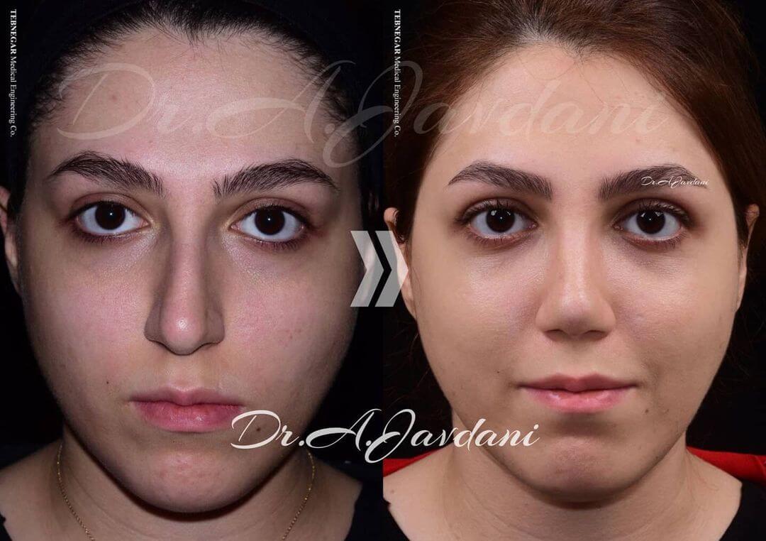 تصویر جراحی بینی طبیعی قبل و بعد از جراحی