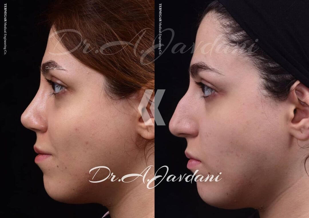 تصویر جراحی بینی قبل و بعد از عمل