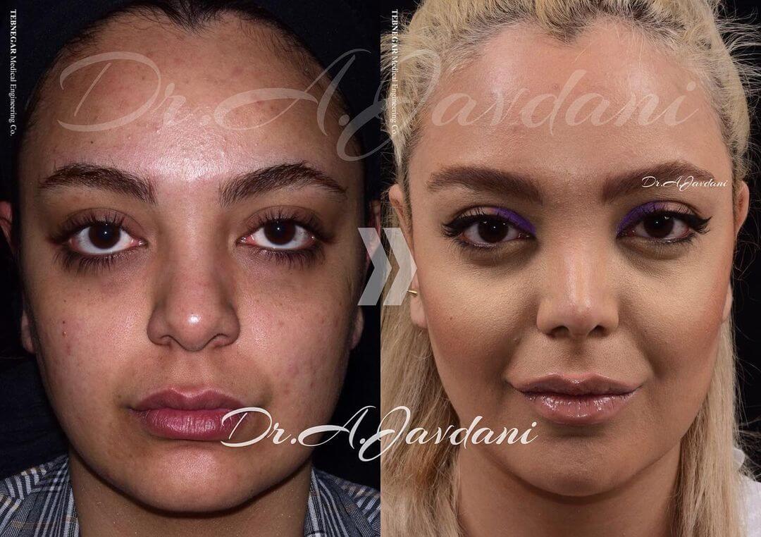 تصویر قبل و بعد از عمل بینی