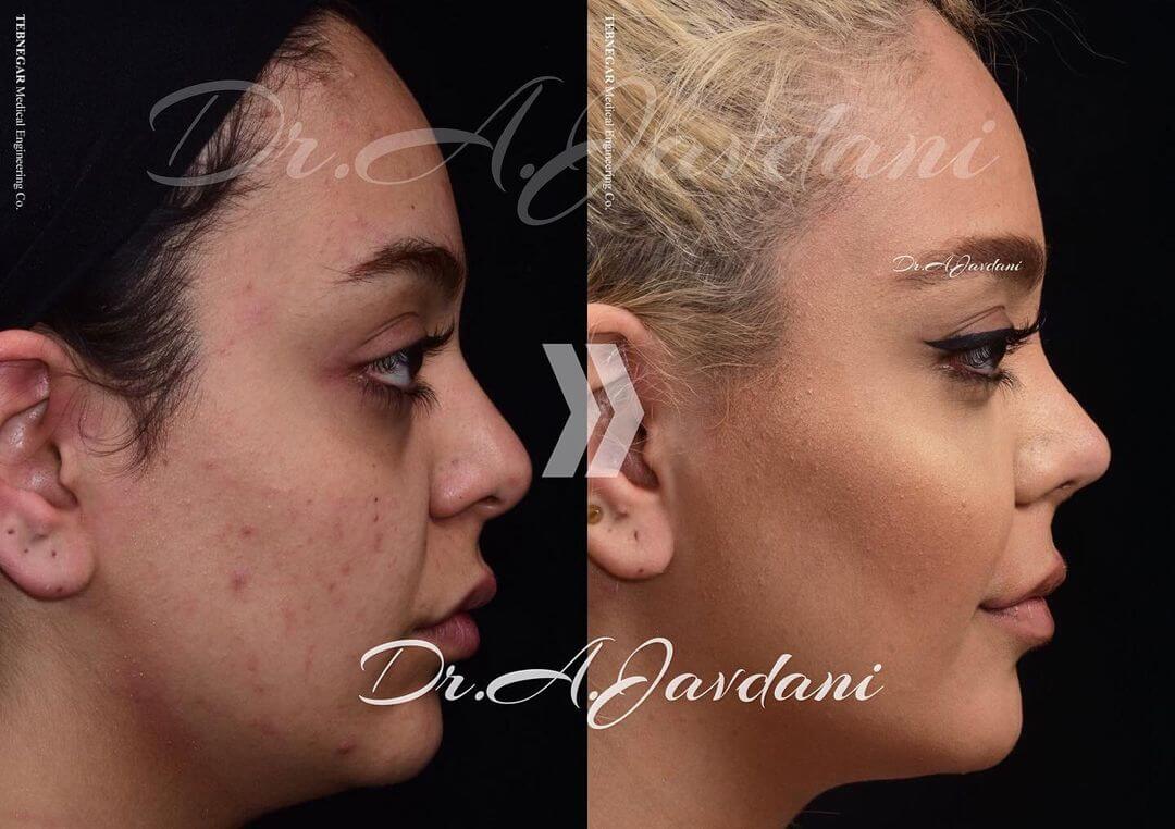 تصویر قبل و بعد از جراحی بینی