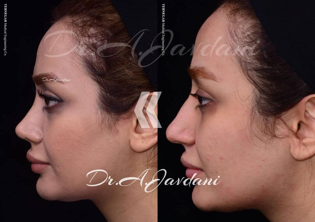 تصویر رینوپلاستی قبل و بعد از جراحی