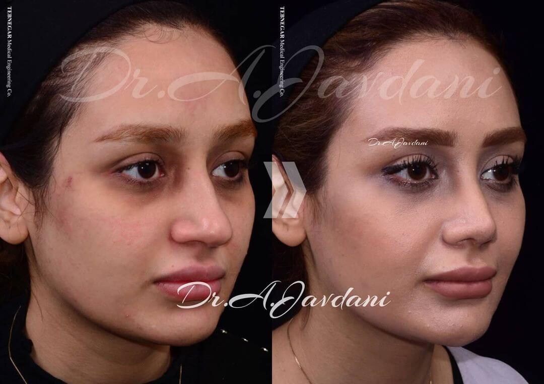 تصویر جراحی بینی قبل و بعد از جراحی