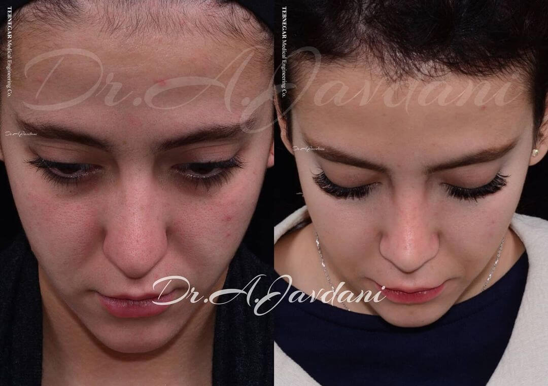 تصویر عمل بینی قبل و بعد از عمل
