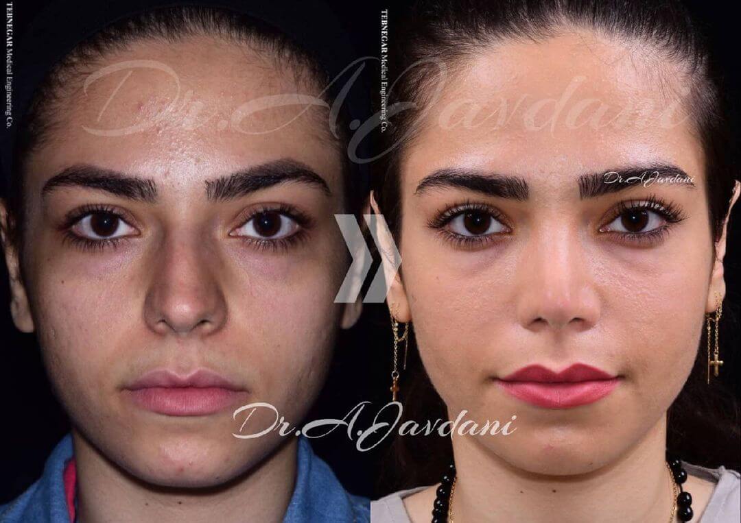 تصویر قبل و بعد از جراحی بینی گوشتی