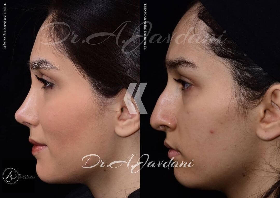 تصویر قبل و بعد از جراحی رفع انحراف بینی