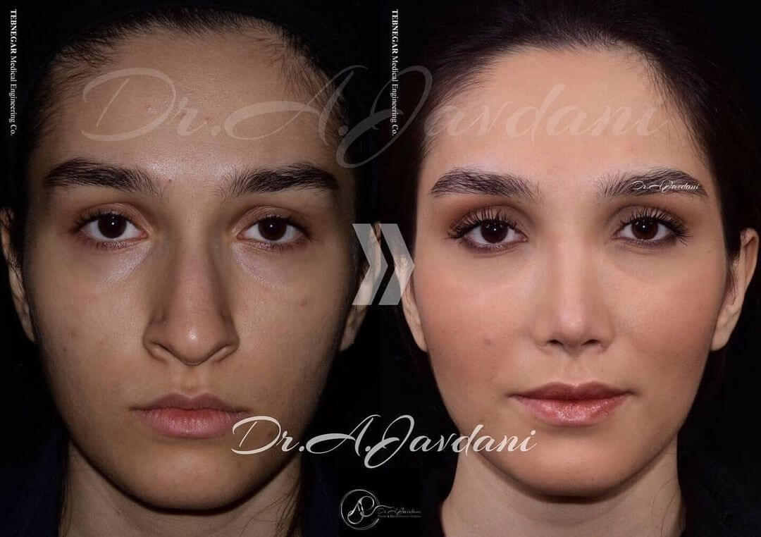تصویر قبل و بعد از عمل زیبایی اولیه ی بینی