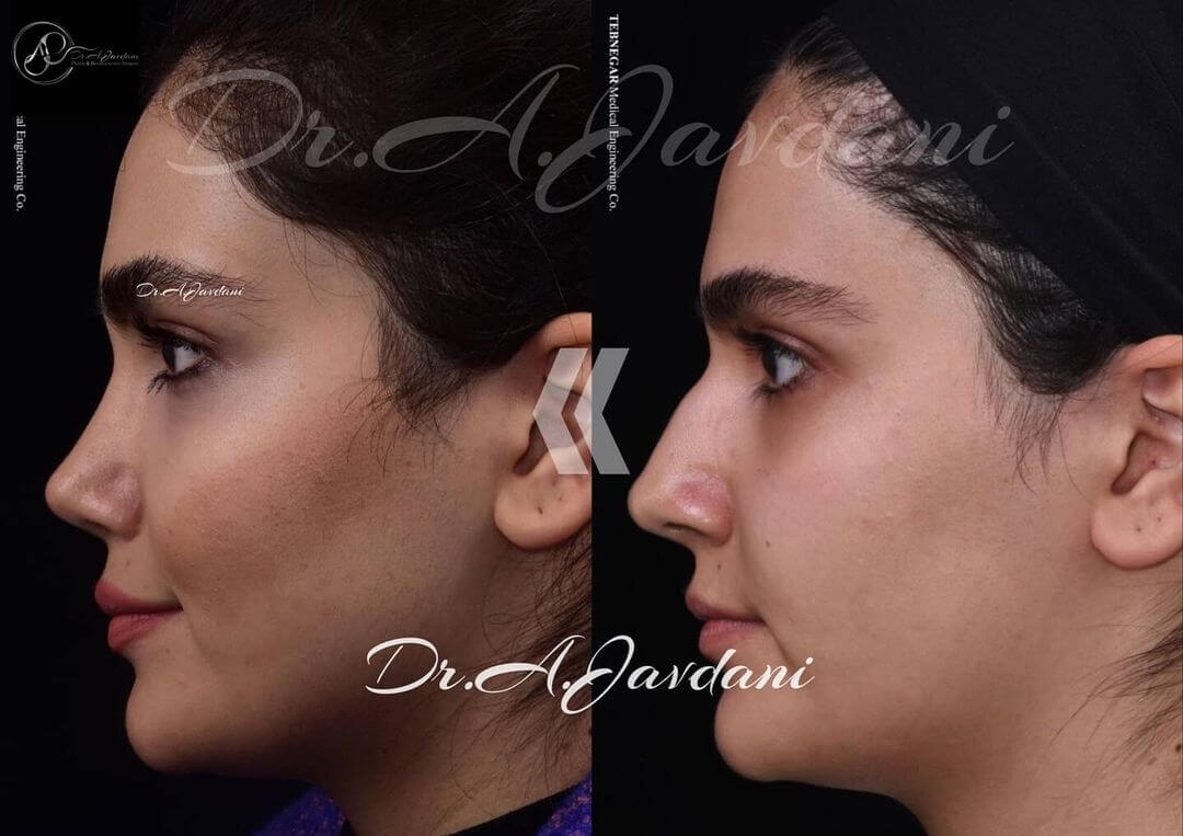 تصویر قبل و دوماه بعد از جراحی بینی