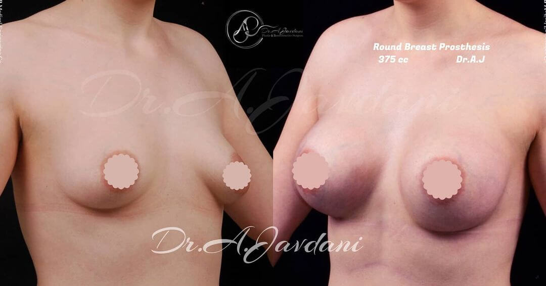 تصویر قبل و بعد از جراحی پروتز سینه