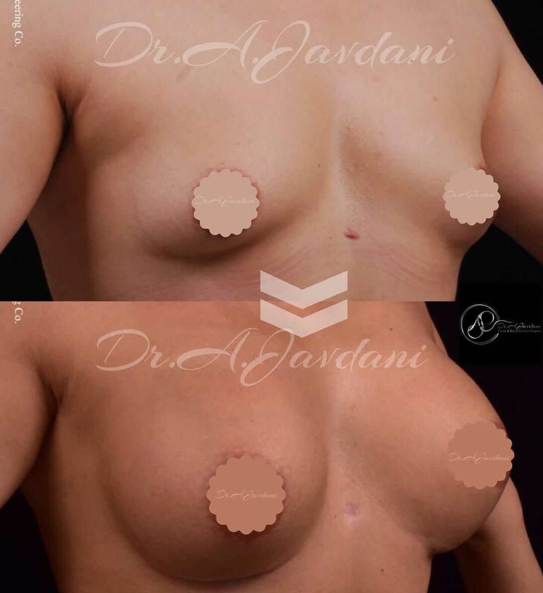 تصویر جراحی بزرگ کردن سینه با پروتز
