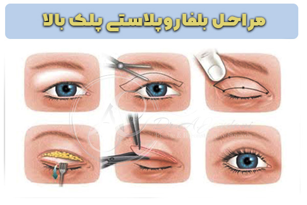 بلفاروپلاستی - دکتر جاودانی