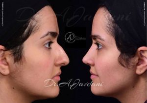 عمل بینی طبیعی - دکتر جاودانی