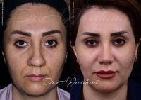 عمل بینی گوشتی - دکتر جاودانی