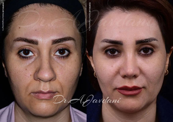 عمل بینی گوشتی - دکتر جاودانی