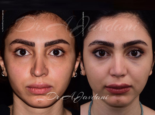 عمل ترمیمی بینی - دکتر جاودانی