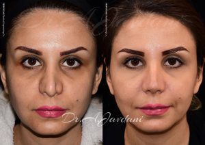 عمل ترمیمی بینی - دکتر جاودانی
