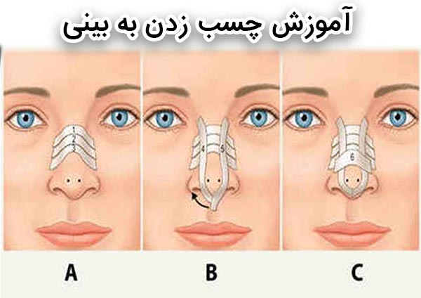 آموزش چسب زدن به بینی - دکتر جاودانی