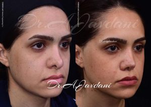 جراحی ترمیمی بینی - دکتر جاودانی