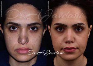 جراحی ترمیمی بینی - دکتر جاودانی