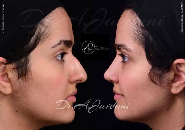 عمل بینی طبیعی - دکتر جاودانی