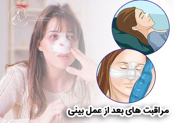 مراقبت های بعد از عمل بینی - دکتر جاودانی