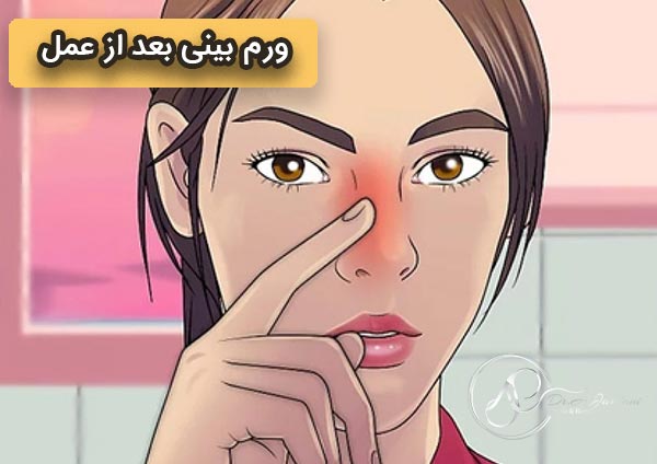 ورم بینی بعد از عمل - دکتر جاودانی