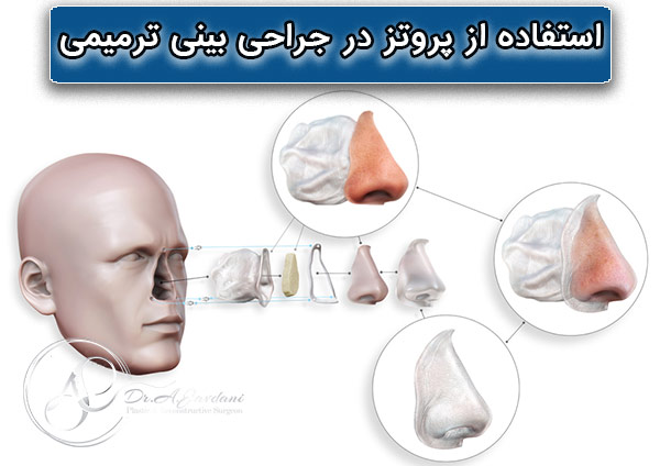 پروتز در جراحی بینی ترمیمی - دکتر جاودانی