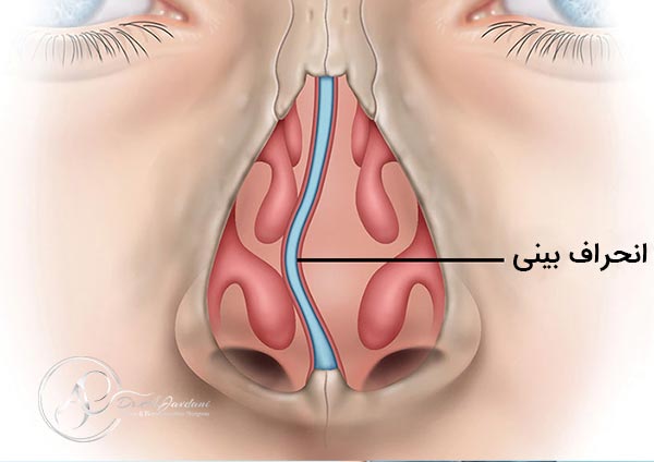 انحراف بینی - دکتر جاودانی