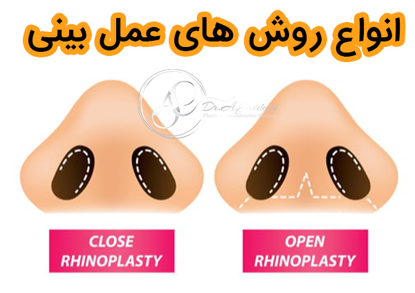 انواع روش های عمل بینی - دکتر جاودانی