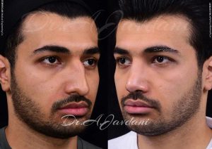 عمل بینی مردانه - دکتر جاودانی