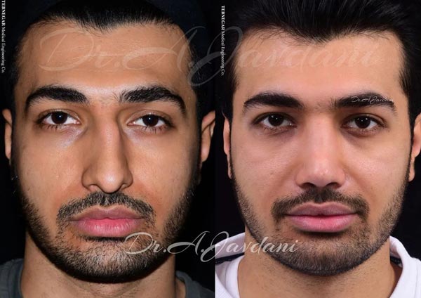 عمل بینی کج - دکتر جاودانی