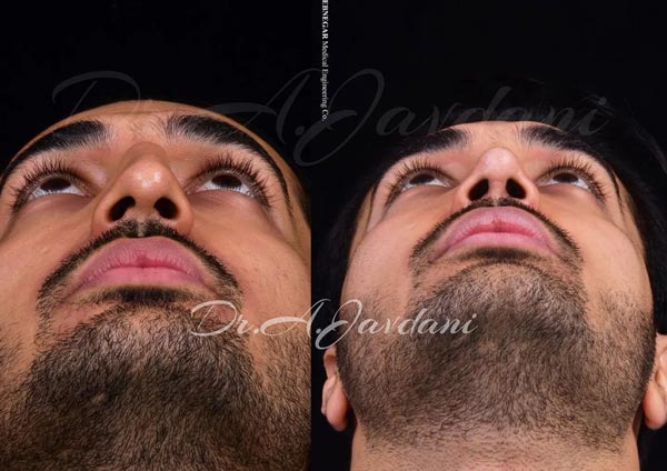 عمل بینی کج - دکتر جاودانی