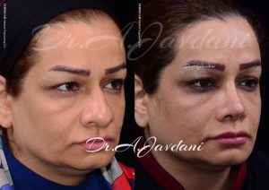 عمل بینی گوشتی - دکتر جاودانی