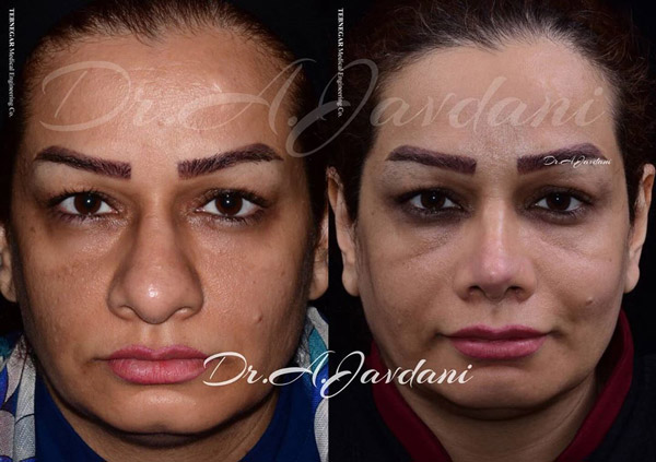 عمل بینی گوشتی - دکتر جاودانی