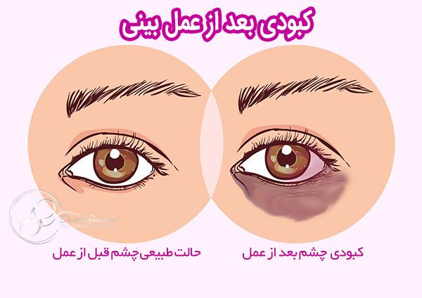 کبودی بعد از عمل بینی - دکتر جاودانی