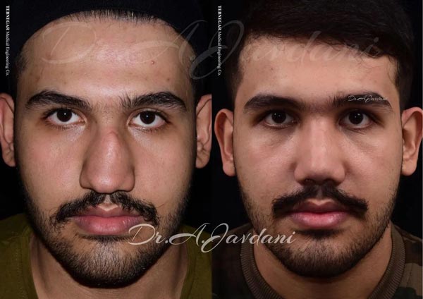 عمل بینی شکسته - دکتر جاودانی