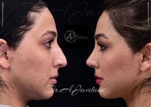 عمل بینی طبیعی - دکتر جاودانی