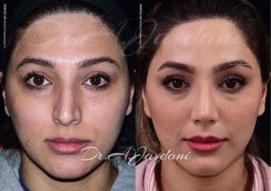 عمل بینی طبیعی - دکتر جاودانی