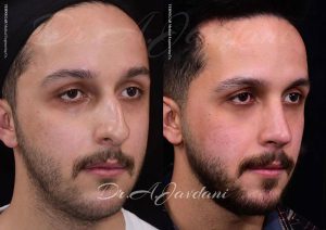 جراحی بینی مردانه - دکتر جاودانی