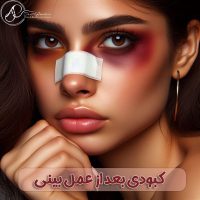 کبودی بعد از عمل بینی - دکتر علی جاودانی