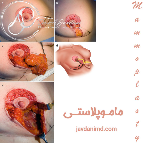 ماموپلاستی - دکتر علی جاودانی