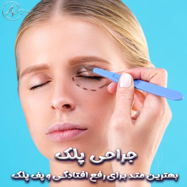 جراحی پلک - دکتر علی جاودانی